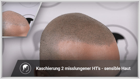 Kaschierung 2 misslungener Haartransplantationen - sensible Haut
