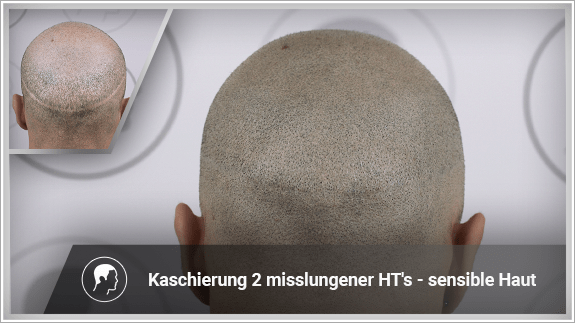Kaschierung 2 misslungener Haartransplantationen - sensible Haut